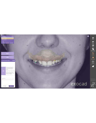 Exocad DentalCAD [Flex]