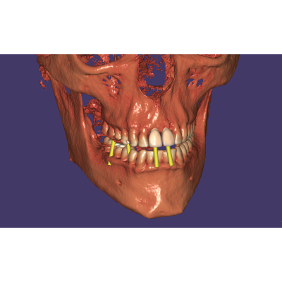 Exocad DentalCAD [Flex]